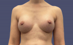 Breast Augmentation 27 After